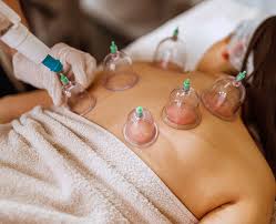 Cupping Therapy for muscle tension and pain relief